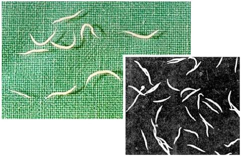 pinworms az emberi testből