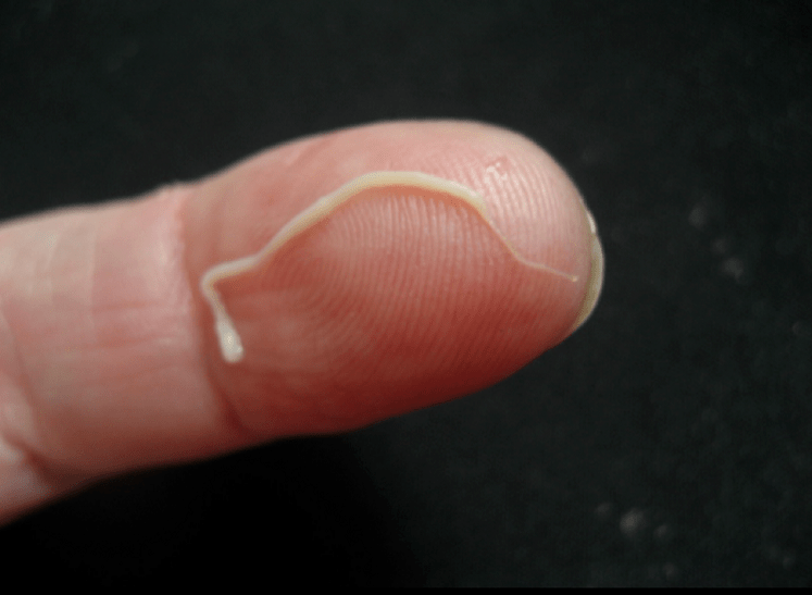 orsóféreg parazita az emberi szervezetből